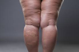 Lipedema: o mês da conscientização sobre a doença que atinge milhões de mulheres brasileiras
