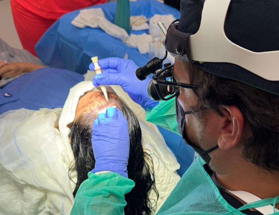 Transplante capilar com fio longo oferece alternativa médica menos invasiva e mais discreta
